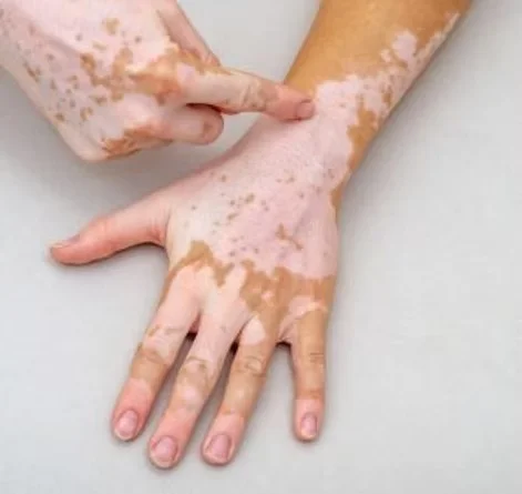 Tratamento de Vitiligo