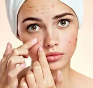 Tratamento de Acne