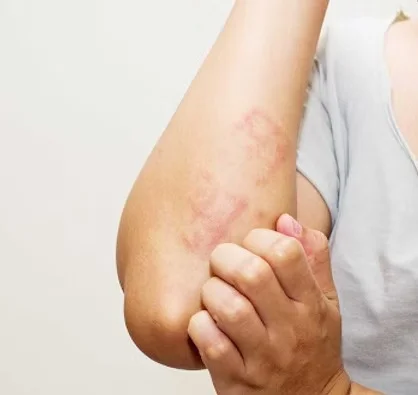 Tratamento de Dermatites