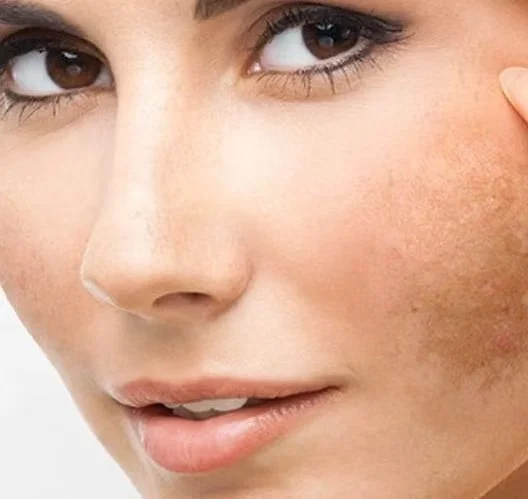 Tratamento para Melasma