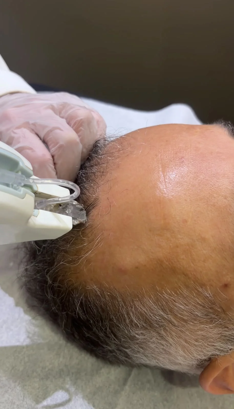 alopecia androgenética