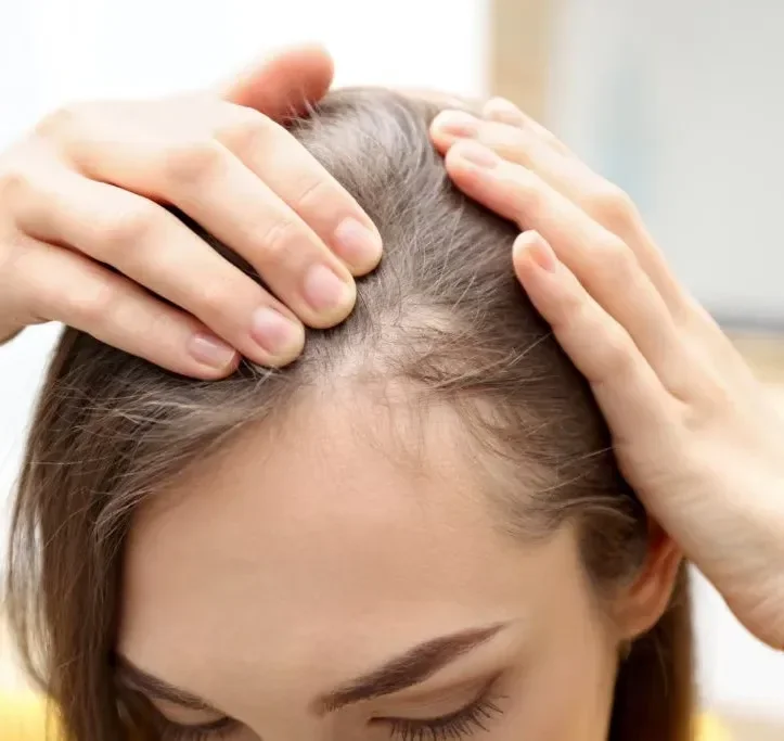 alopecia de tração tratamento
